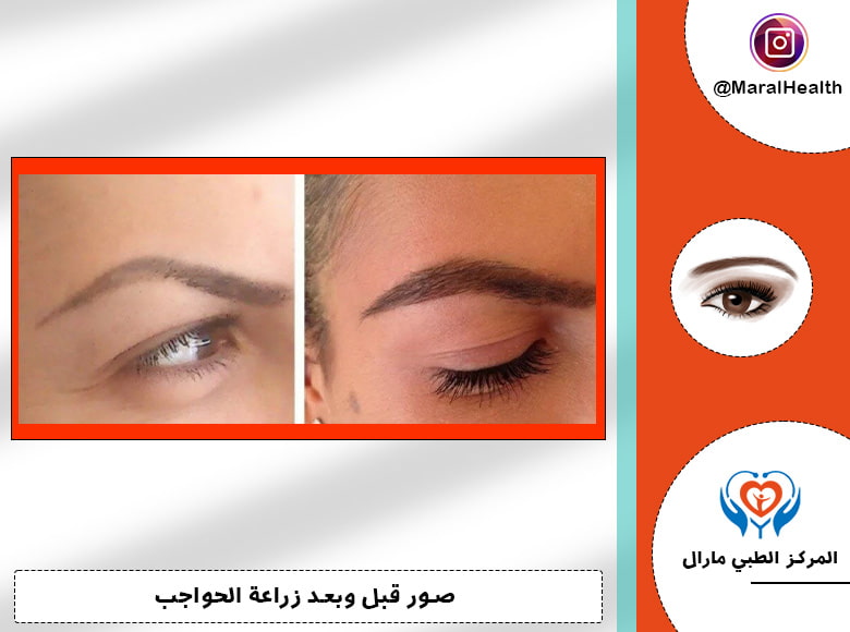أفضل مركز لزراعة الشعر الحواجب