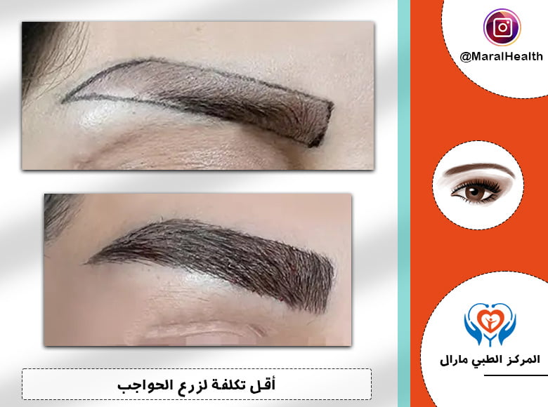 أقل تكلفة لزرع الحواجب