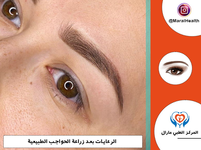 التحقق في أضرار زرع الحواجب