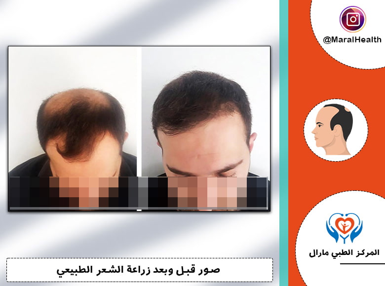 بتقنية FUE