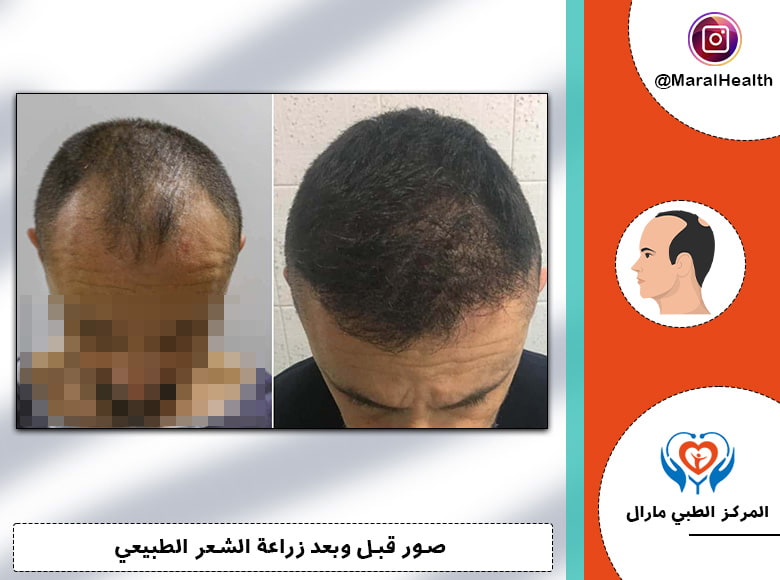 بتقنية FUT