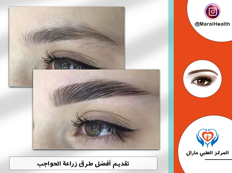 تقديم أفضل طرق زراعة الحواجب