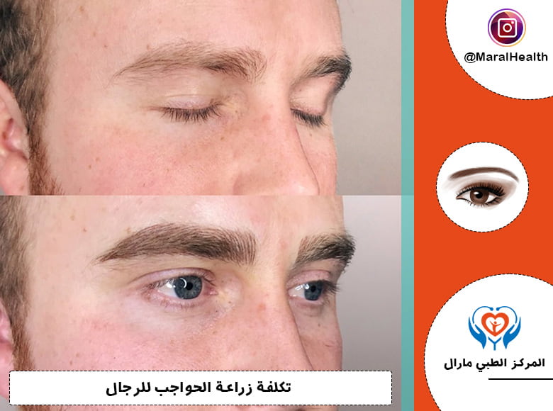 تكلفة زراعة الحواجب للرجال