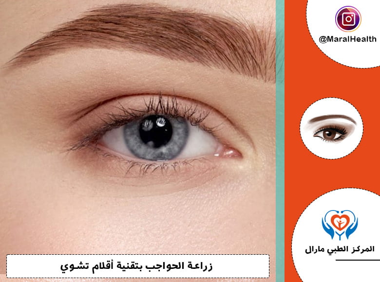 زراعة الحواجب بتقنية أقلام تشوي DHI