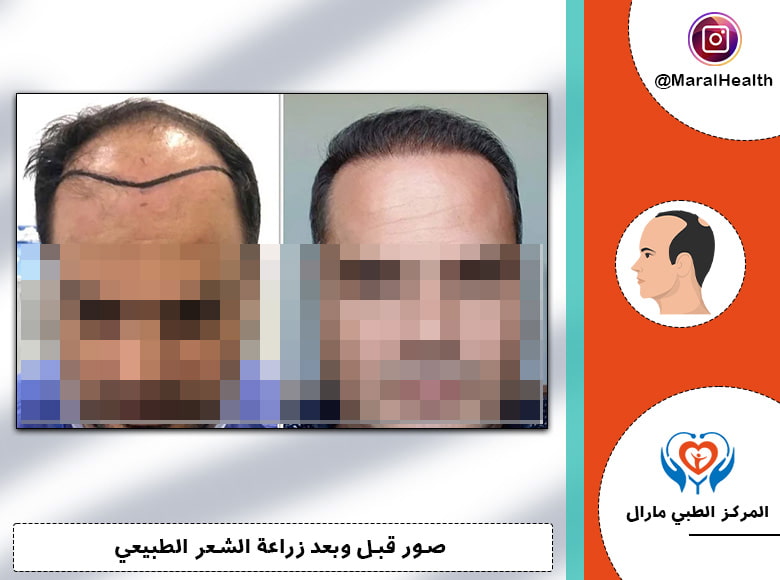 تقنية DHI