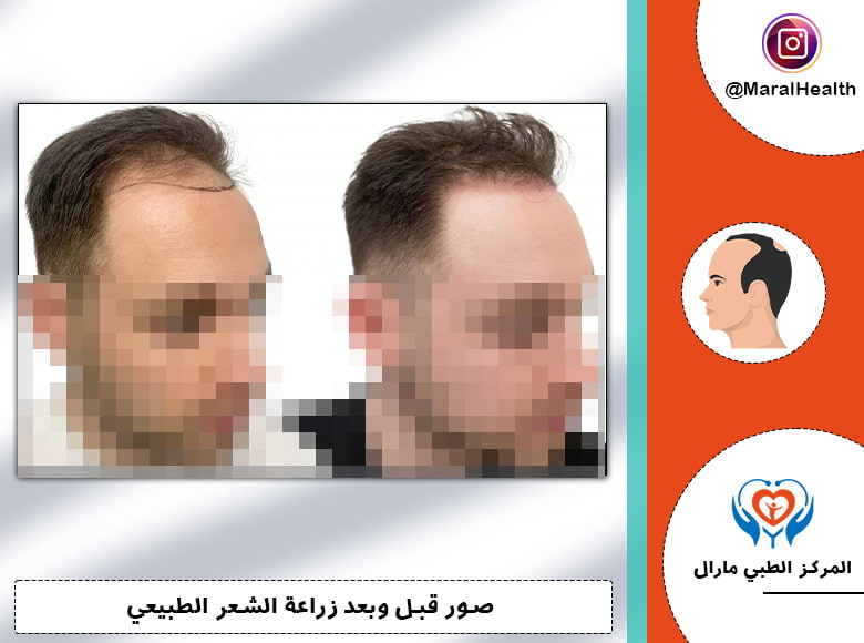 زراعة الشعر بالطريقة المركبة