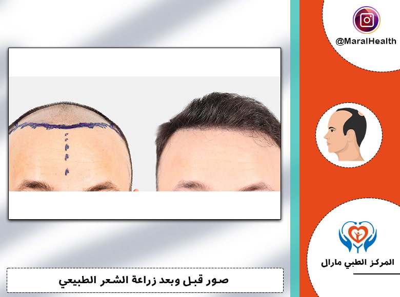 زراعة الشعر بتقنية Super FUE