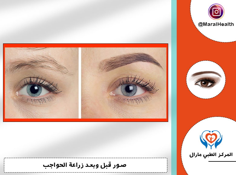صور زراعة الحواجب