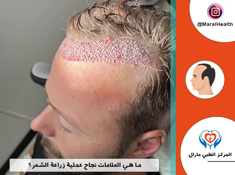 ما هي العلامات نجاح عملية زراعة الشعر؟