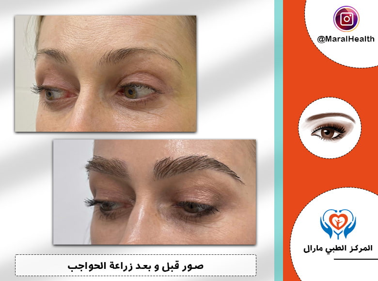 تجربتي مع زراعة الحواجب
