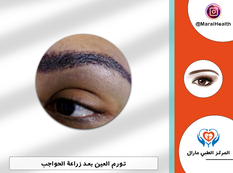 تورم العين بعد زراعة الحواجب