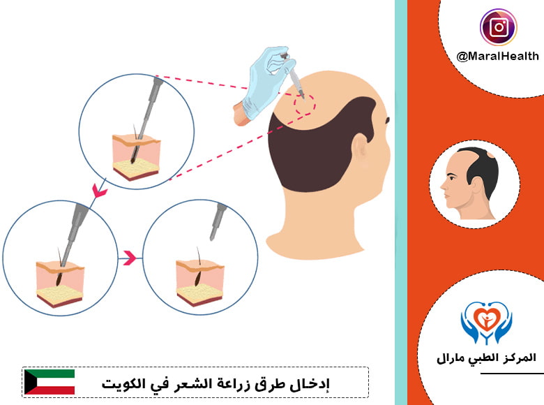 إدخال طرق زراعة الشعر في الكويت
