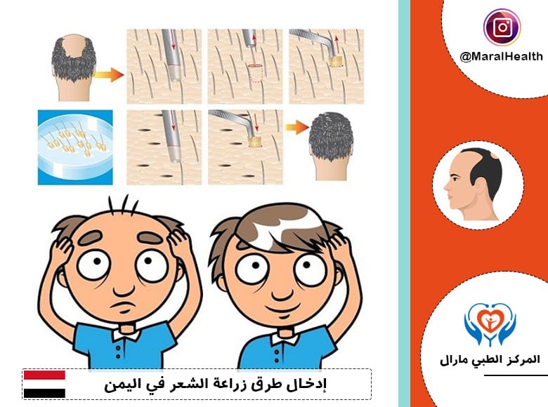 إدخال طرق زراعة الشعر في اليمن