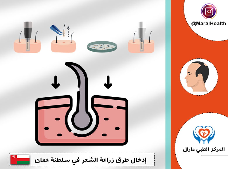 إدخال طرق زراعة الشعر في سلطنة عمان