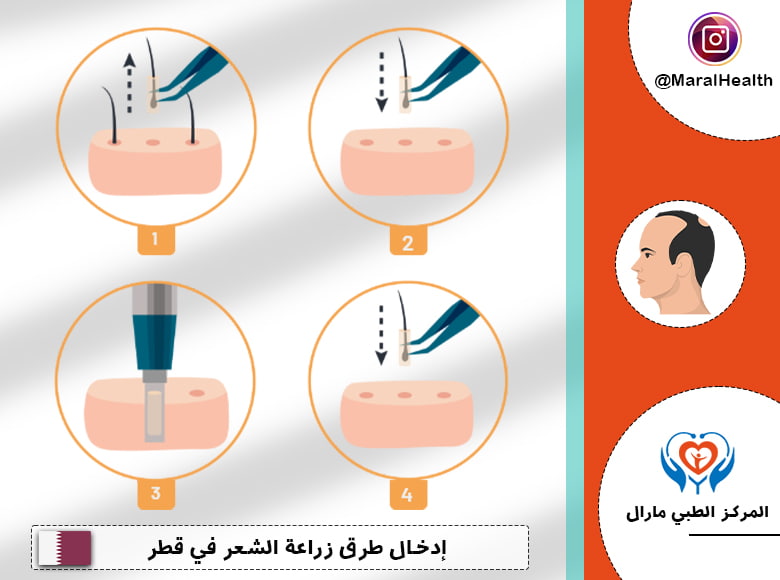 إدخال طرق زراعة الشعر في قطر