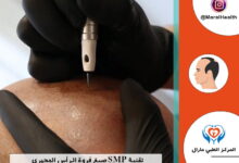 تقنية SMP صبغ فروة الرأس المجهري