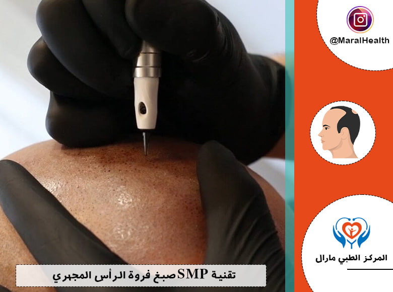 تقنية SMP صبغ فروة الرأس المجهري