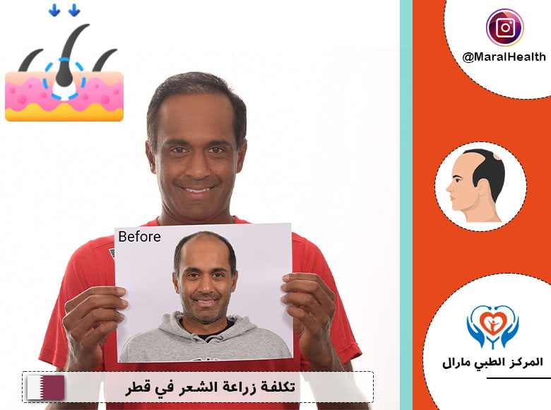 تكلفة زراعة الشعر في قطر