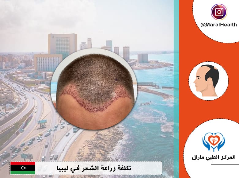 تكلفة زراعة الشعر في ليبيا 2023