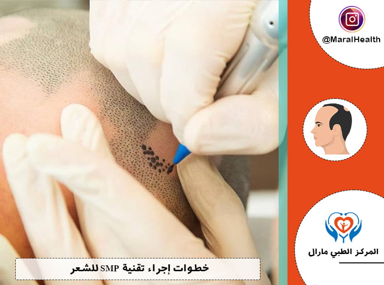 خطوات إجراء تقنية SMP للشعر