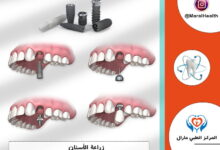 زراعة الأسنان | التكلفة - المضاعفات والطرق البديلة 2023 | لمرکز الطبي مارال