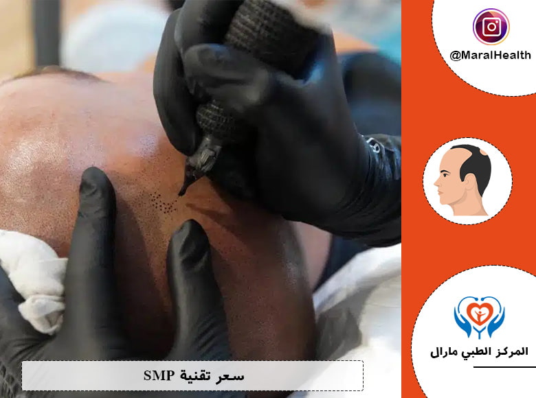 سعر تقنية SMP