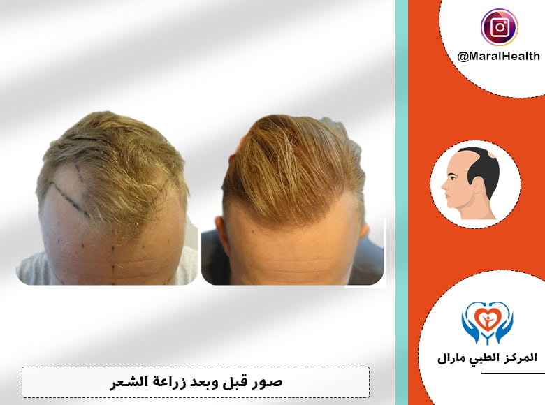 صور زراعة الشعر عالي الكثافة
