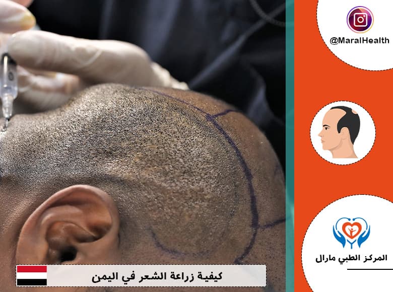 كيفية زراعة الشعر في الیمن