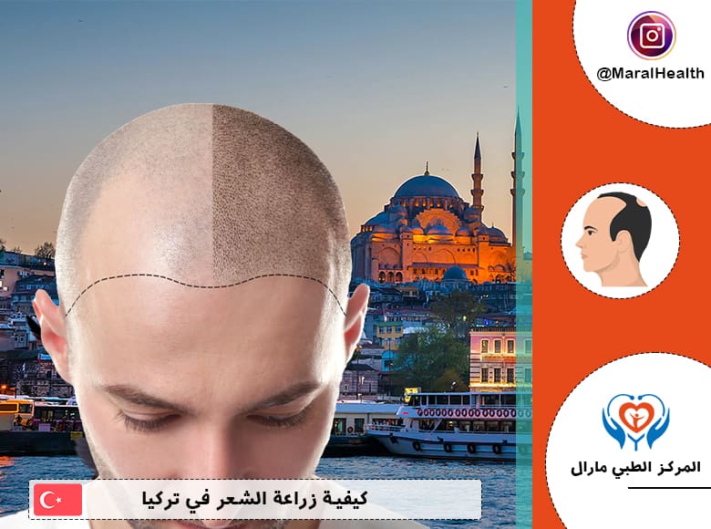 كيفية زراعة الشعر في مركز العناية بالشعر والبشرة في ترکیا