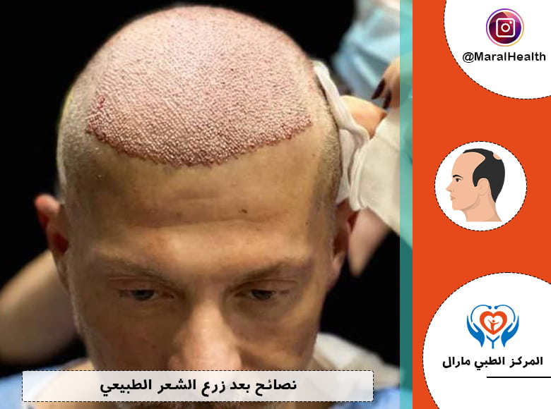 نصائح بعد زرع الشعر الطبيعي